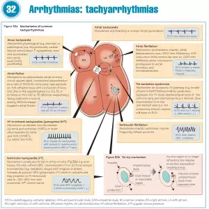 Arrythmias - tachyarrythmias